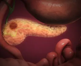 Un tratamiento oral marca un antes y un después en cáncer de páncreas avanzado