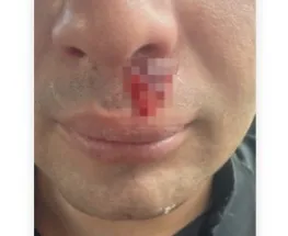 Policía herido tras feroz ataque a piedrazos en Santa Lucía