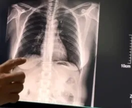 En el Marcial Quiroga, cuatro de cada diez pacientes ya dejaron el cigarrillo